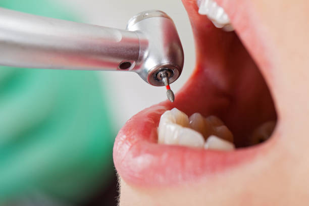 Best Chipped Tooth Repair Near Me  in Fayetteville, AR
